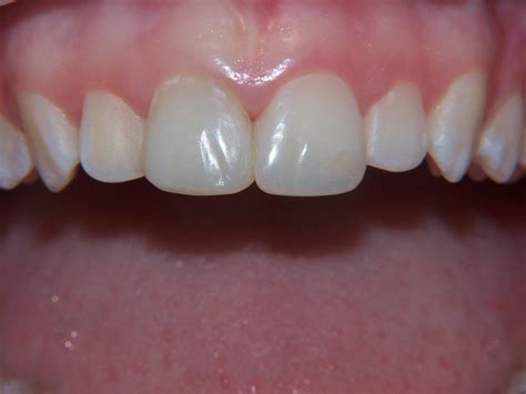 resin veneers|Iba pa.